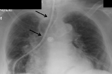 X-ray of patient
