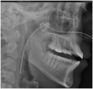 nasogastric tube